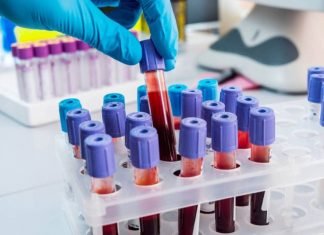 Estudio revela la influencia de alteraciones hematológicas en Covid-19