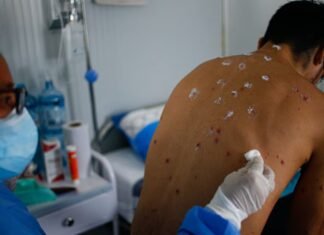 OMS intenta transmitir tranquilidad ante brote de mpox en Africa y un único caso en Europa